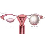 کیست تخمدان