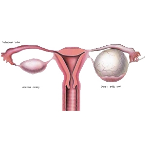 کیست تخمدان